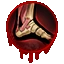 Sprained Ankle